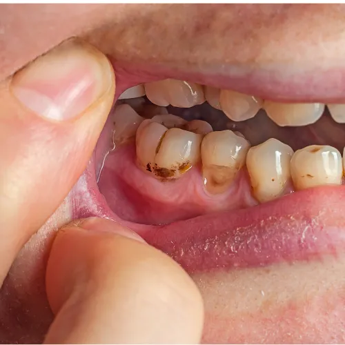 Surface staining on teeth from beverages