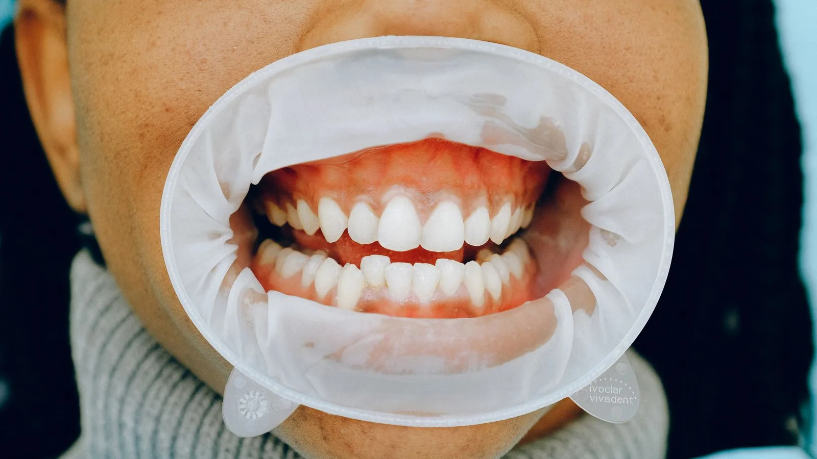 Close-up of a patient's teeth and gums during a dental examination